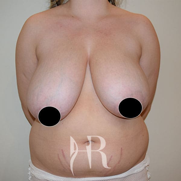 HR Plastic Surgery - Breast Reduction patient before 4